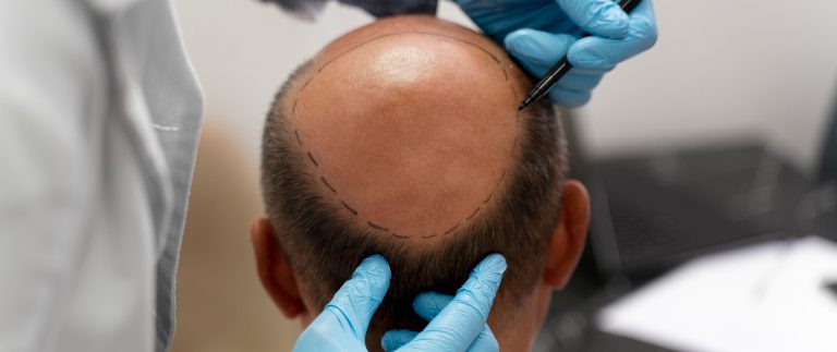 Hair transplants are expensive initially, but can be economical