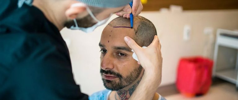What is Implanter Pen in DHT Hair Transplant?