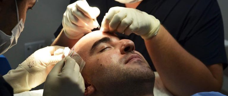 On the other hand, FUE involves removing individual hair