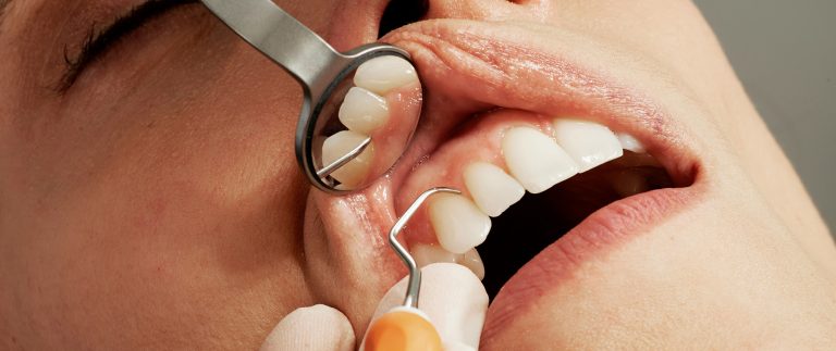 When you need a dental filling?